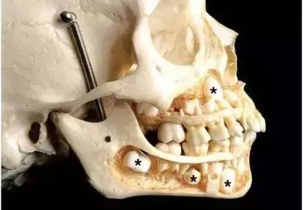 修复一颗蛀牙的全过程,蛀牙早期黑点全治好了的感觉真好