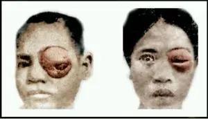 深圳女子零食里吃出铁钉,女子体内取出活虫只因吃这道菜