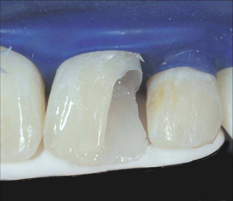 我的烤瓷牙为什么那么厚,我的烤瓷牙脱落怎么办