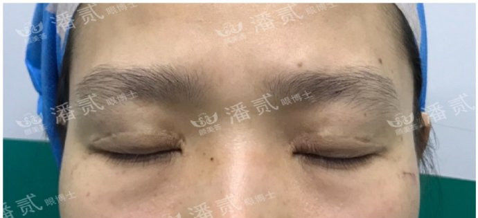 全切双眼皮提肌失败还能修复吗,什么是失败的双眼皮