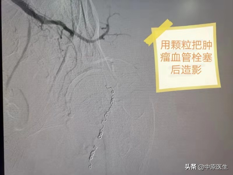 屁股上长个瘤怎么治疗,屁股上长了个瘤20多年了