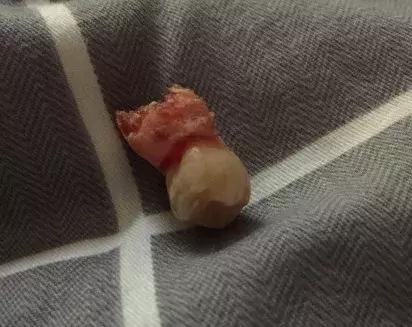 那些不拔智齿的人后来都怎么样了,那些该拔不拔的智齿最后都咋样了