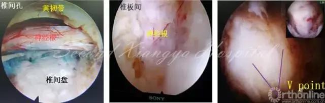 经皮腰椎间盘切除术有何优缺点,什么是经皮内镜腰椎手术