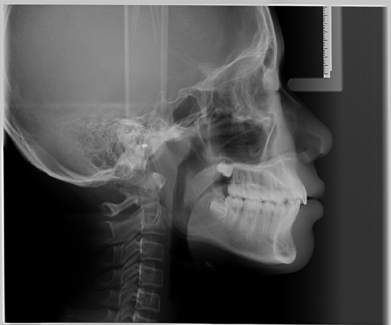 正规的北京牙齿矫正方案,牙齿矫正北京口腔医院