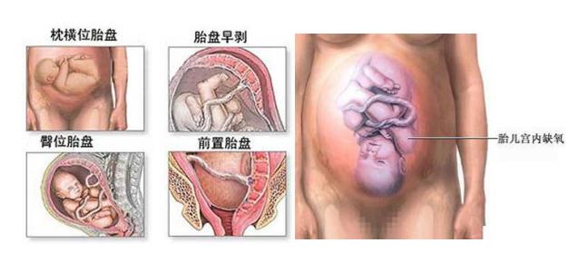 什么是剖腹产粘连,什么是剖腹产