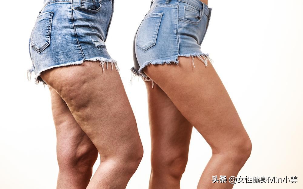 腿上的橘皮组织怎样锻炼,大腿后侧橘皮组织怎么消除