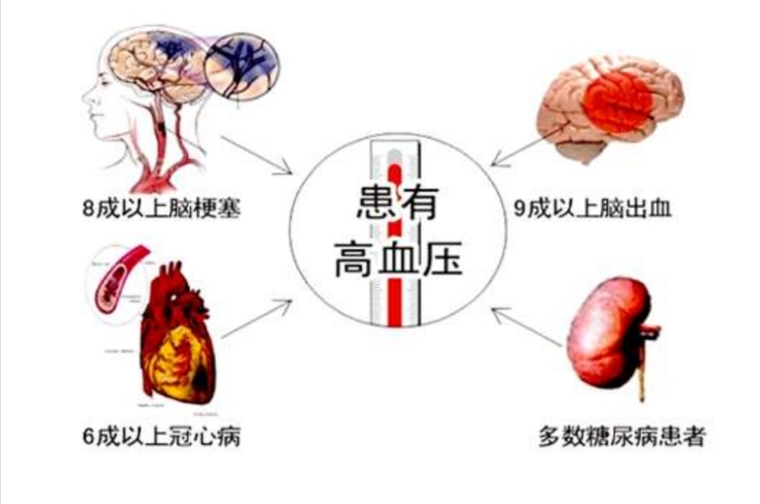 腔隙性脑梗死不吃降压药能治吗,腔隙性脑梗塞能活血吗