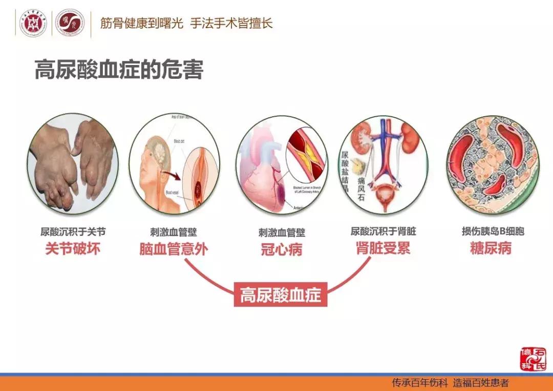 痛风及高尿酸血症患者的生活指导