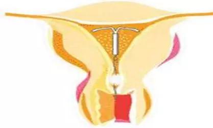 子宫腺肌瘤是癌症早期吗,子宫腺肌症会引起ca125上升多少