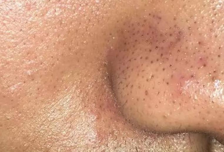 女孩子鼻子黑头怎么去除,鼻子上闭口黑头怎么去掉