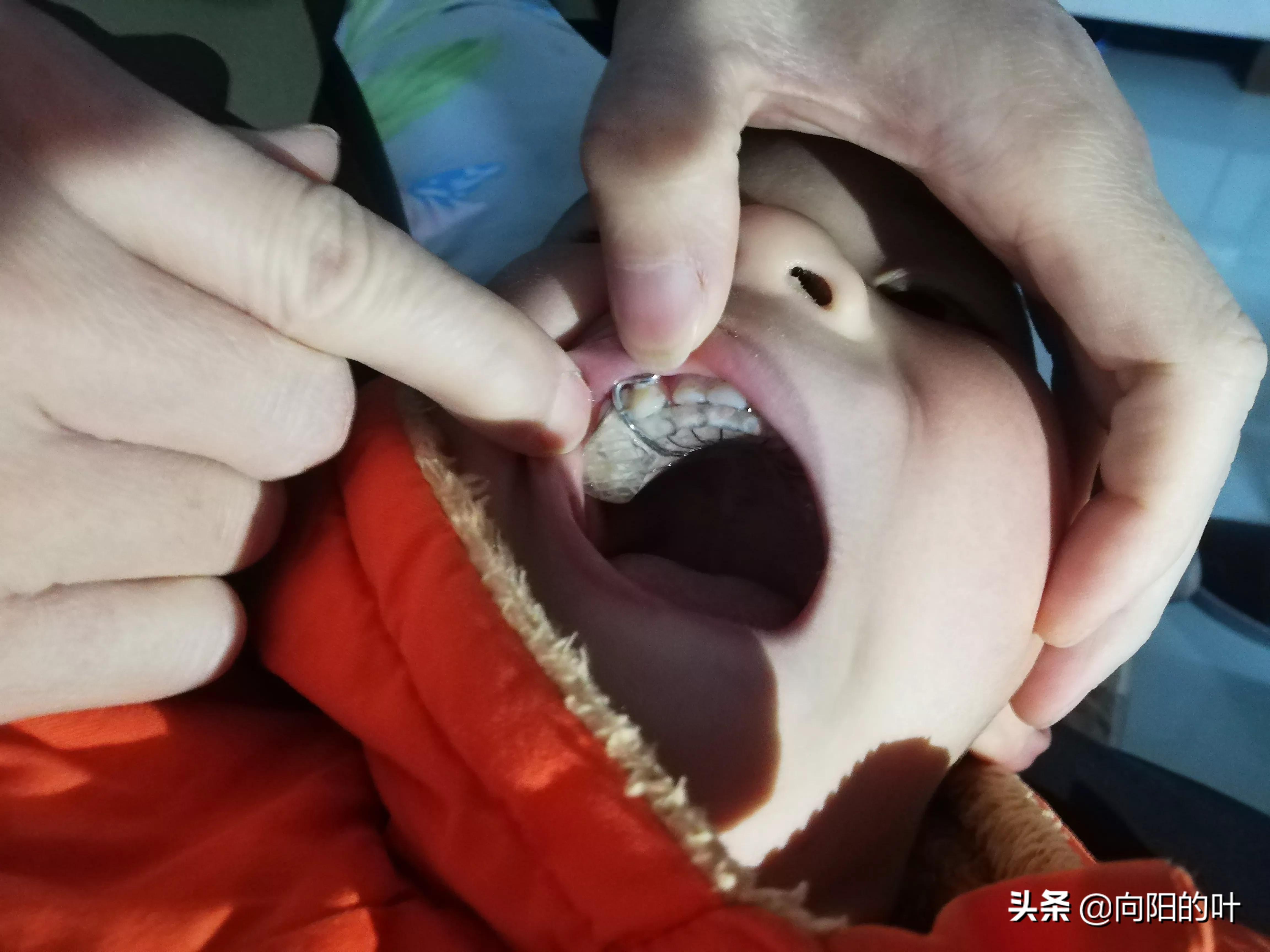 儿童兜齿正畸注意事项,小孩兜齿治疗最佳时间