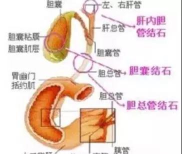 肝胆结石发病急救方法,结石发作真的要命