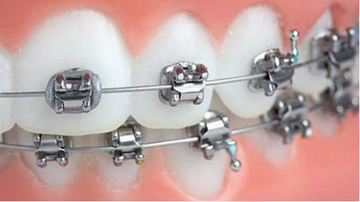 矫正牙齿钢线越来越长扎嘴,牙齿矫正嘴型变美