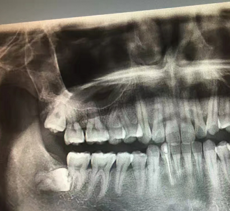 记录一次惨痛的拔牙经历,记一次愉快的拔牙经历