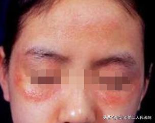 得了皮肌炎,挂号是挂皮肤科?