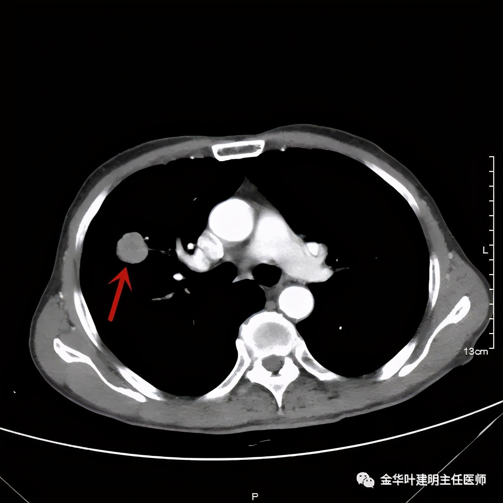 左肺占位被安排穿刺活检是肺癌吗,肺癌肺部穿刺有什么危险