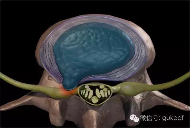 腰突走路1000米可以保守治疗吗,腰突5mm保守治疗可以缩回去吗