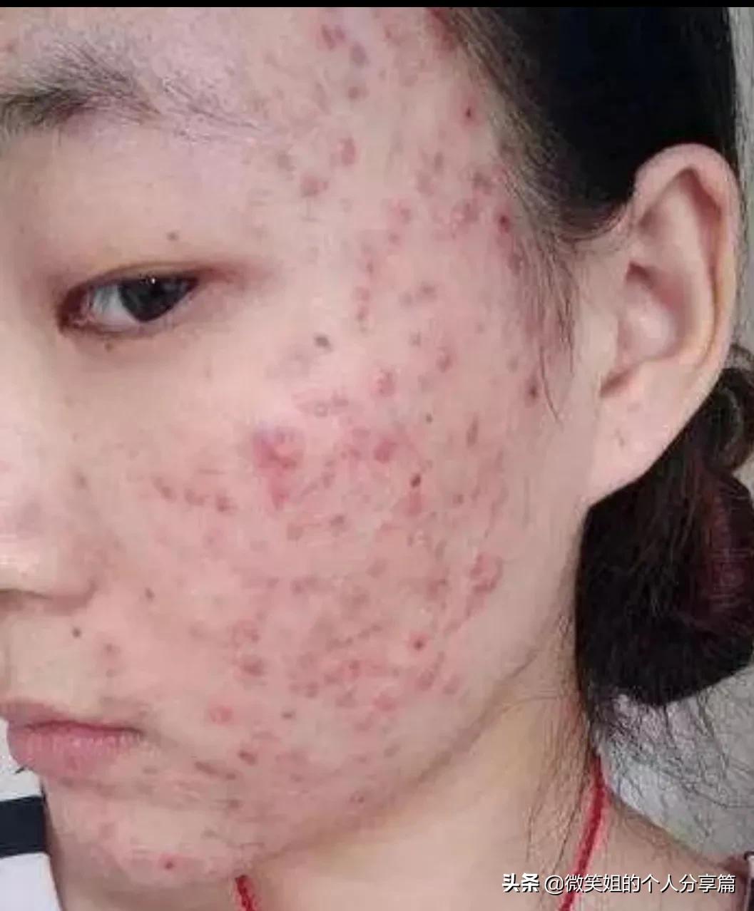 背反复长痘长闭口什么原因,眉间长痘长闭口是什么原因