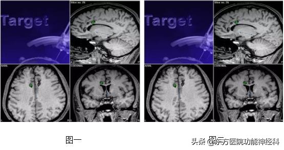 精神病人的前世,精神科药物的前世今生