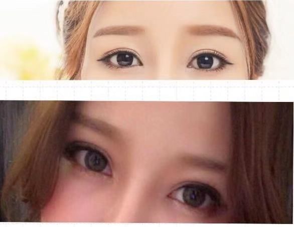 戚薇双眼皮修复视频完整版,戚薇肉条双眼皮是如何恢复的