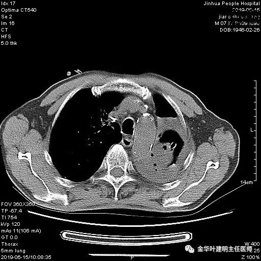 手术引起乳糜胸,有没有做了肺结节手术后是误诊的