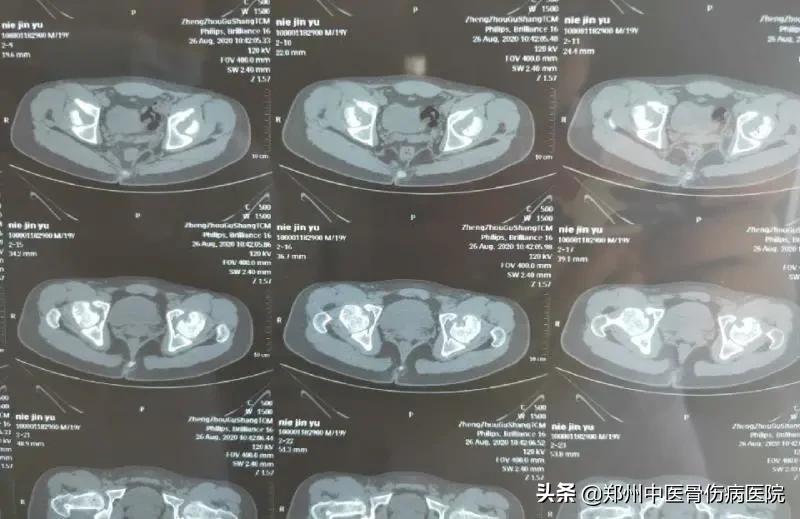 骨坏死中心疑难病例讨论：髋关节的剥脱性骨软骨炎的诊治