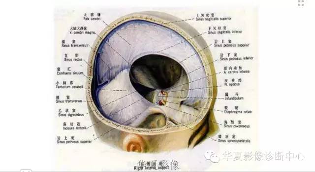 一文读懂颅内胆脂瘤,一文看懂背后的真相