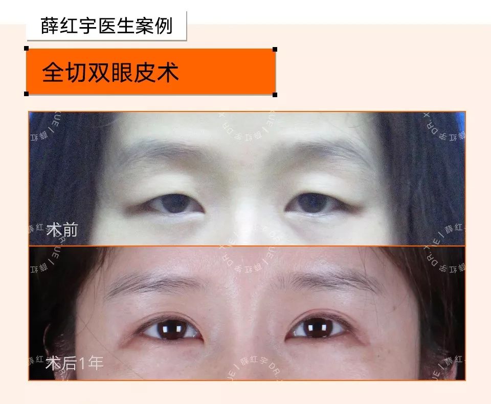 睫毛卷翘的方法半永久,睫毛卷翘定型