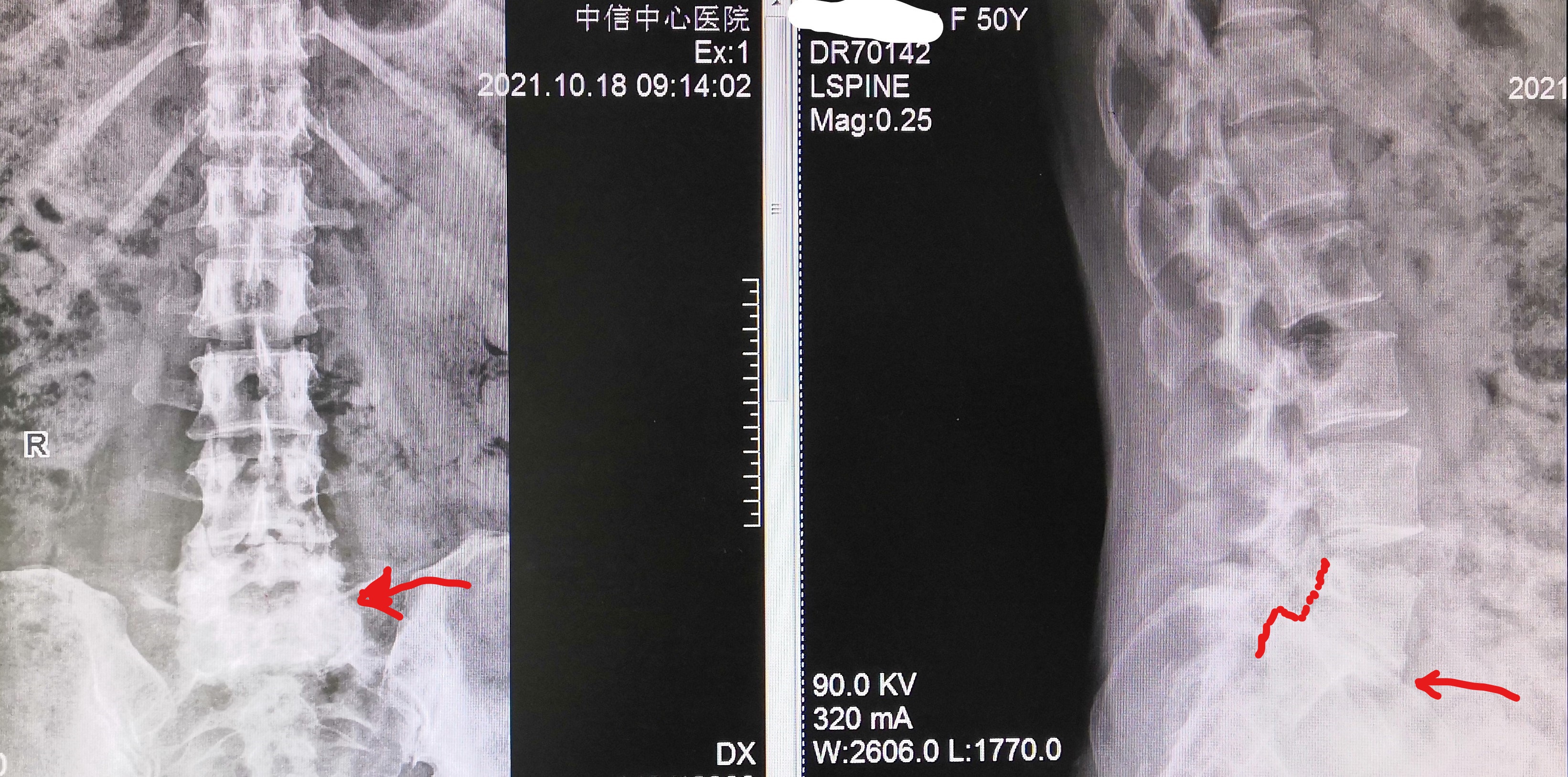 腰椎真性滑脱,手术复位融合固定