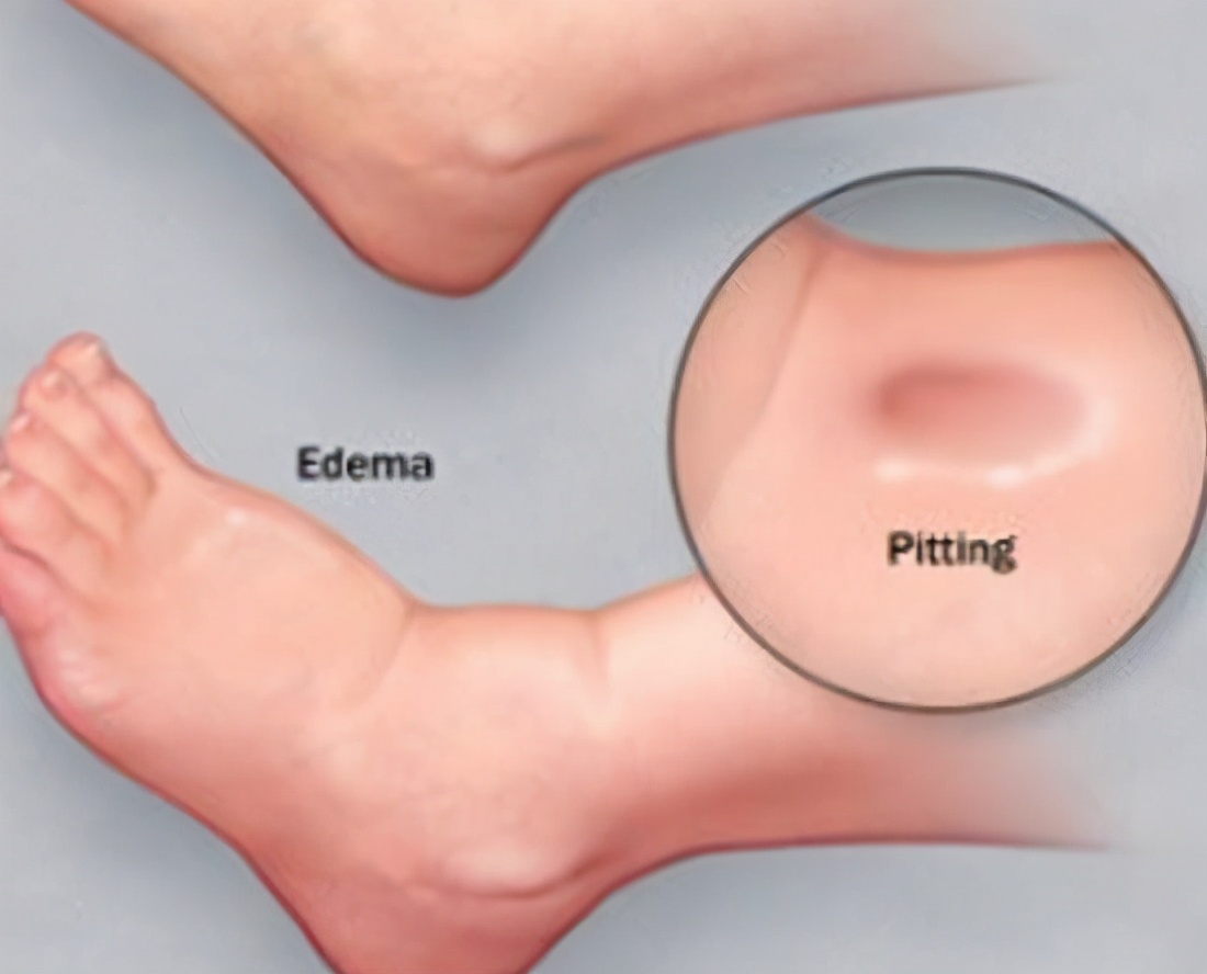 降尿白蛋白高消水肿的中药,肾炎下肢水肿中医辨证治疗
