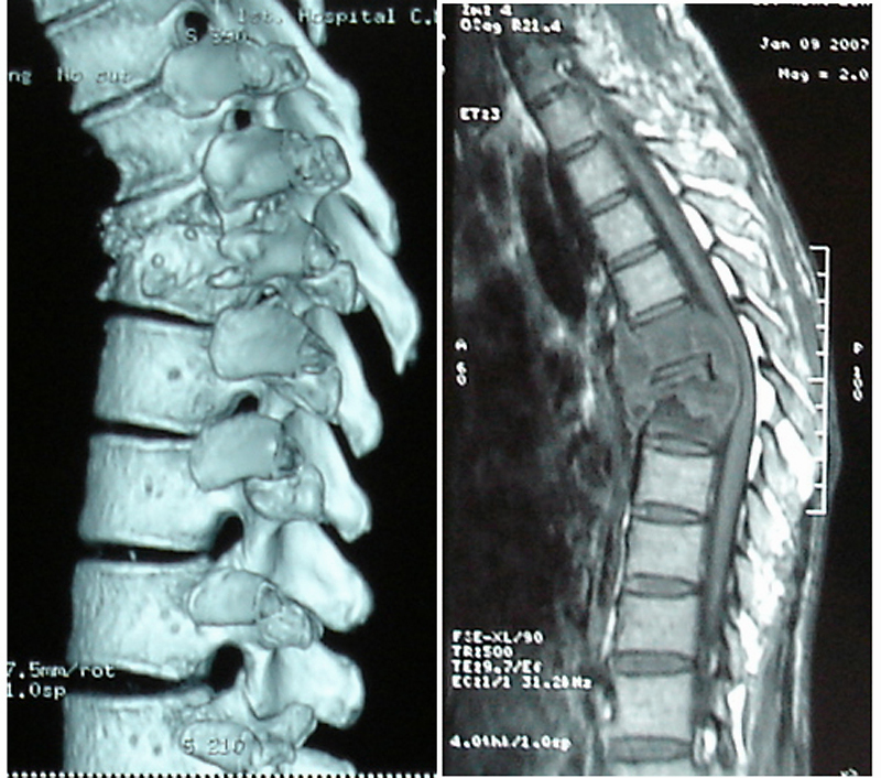 拒绝骨髓手术,中医治疗骨结核