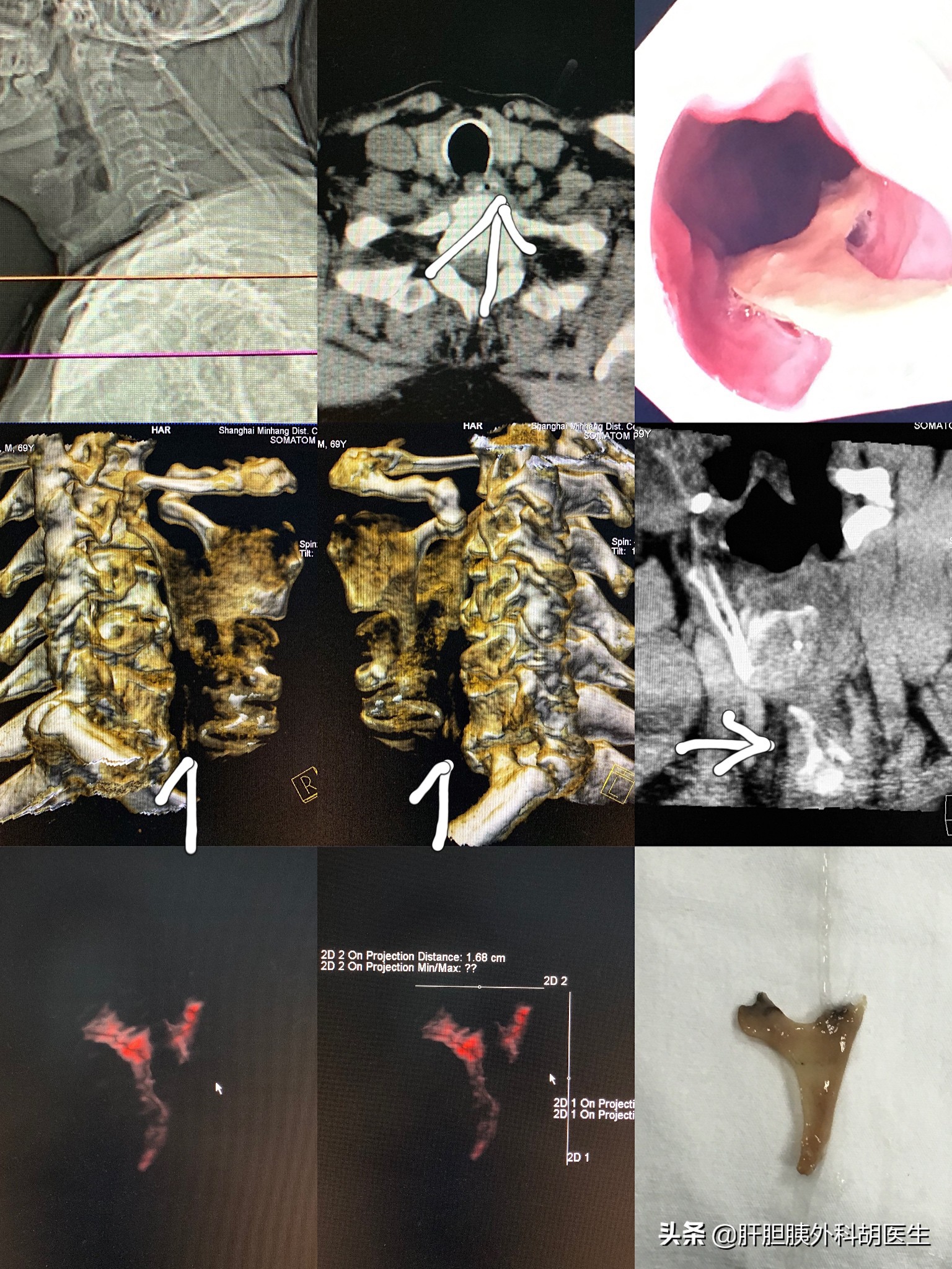 有鱼刺在喉咙里怎么办,有鱼刺扎到手怎么办