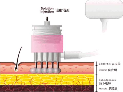 盘点秋冬轻医美项目TOP5