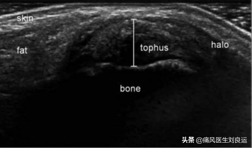 痛风患者查尿酸前能不能吃药,患了痛风到医院要做哪些检查