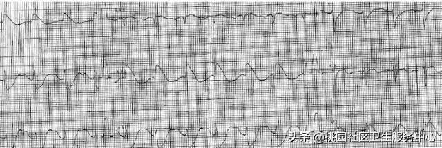早期心梗心电图能查出来吗,警惕这种要命的心电图表现