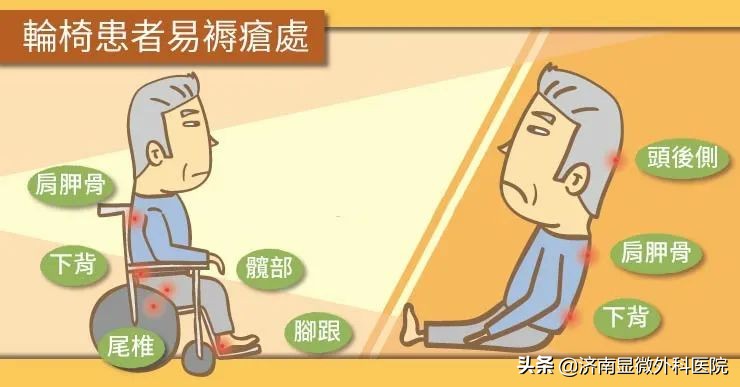 得了褥疮初期怎样治能快速好,褥疮和压疮用什么治疗