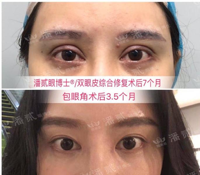 眼睛开内外眼角会过大吗,开内眼角露红肉太多了咋办