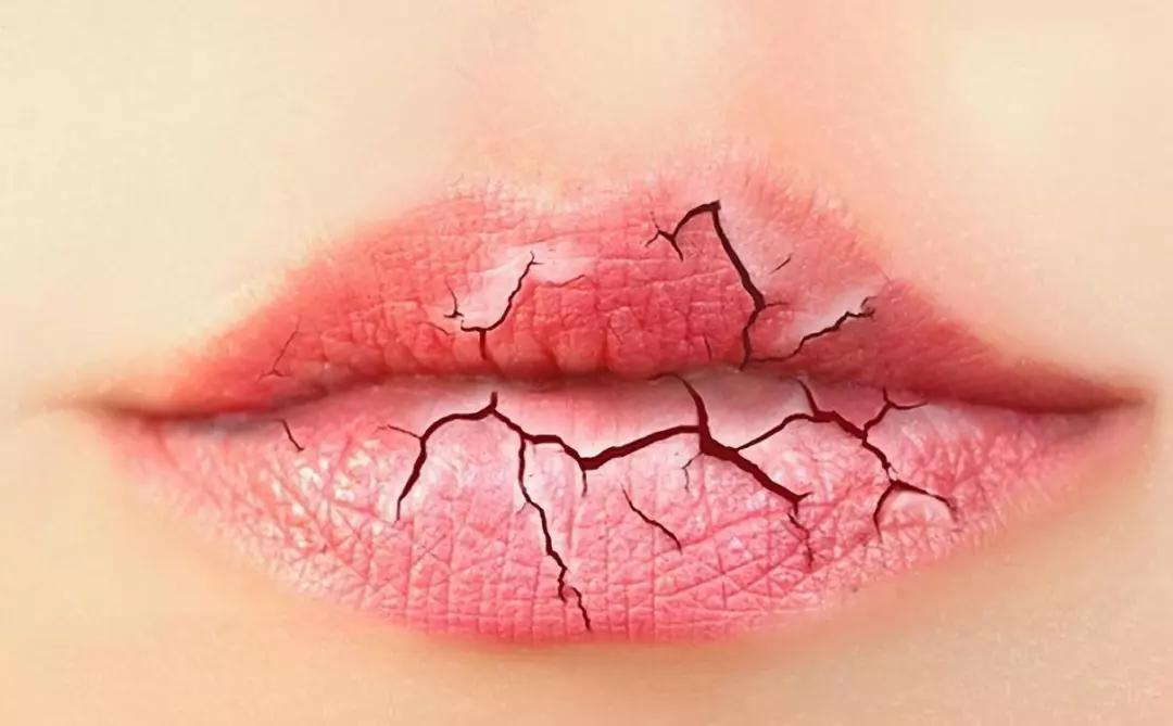 多喝水嘴唇还是干裂起皮怎么办,嘴唇干燥起皮反反复复