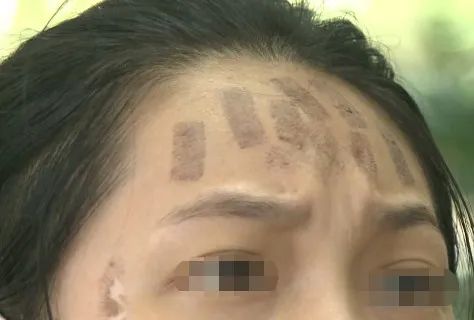 面部皮肤烫伤毁容图片,医院免费治疗毁容女孩