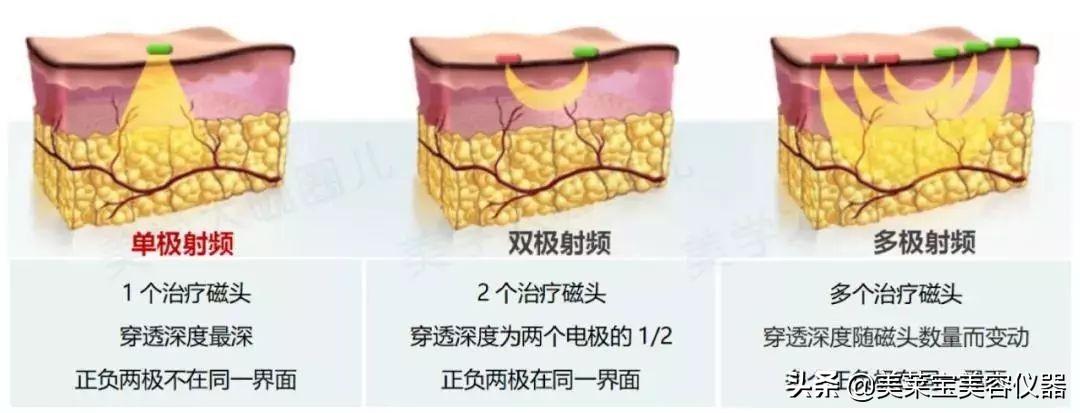 射频美容仪能天天用吗,射频美容仪的凝胶可以替换吗