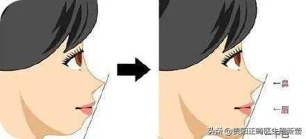 龅牙怎么变好看,龅牙笑起来很难看改善方法