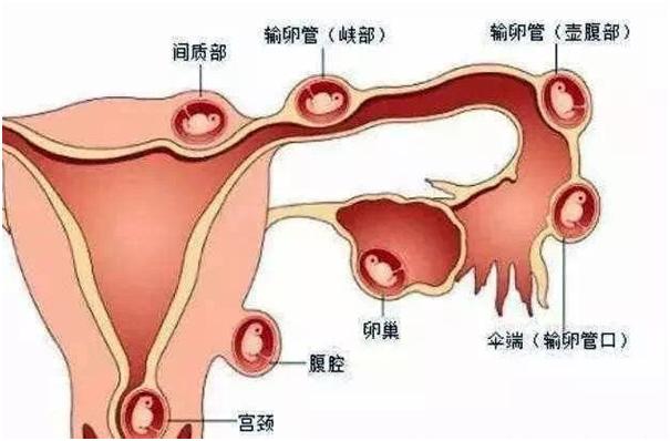 有盆腔炎的女性一般都会宫外孕吗,为什么盆腔炎会宫外孕