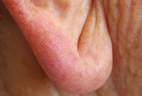 耳垂有一道折痕和心脏有关吗,耳垂有折痕一定是心脏有问题吗