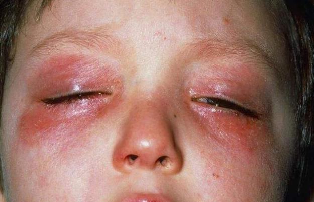 宝宝摸了水银然后揉眼睛,孩子用手摸水银了怎么处理