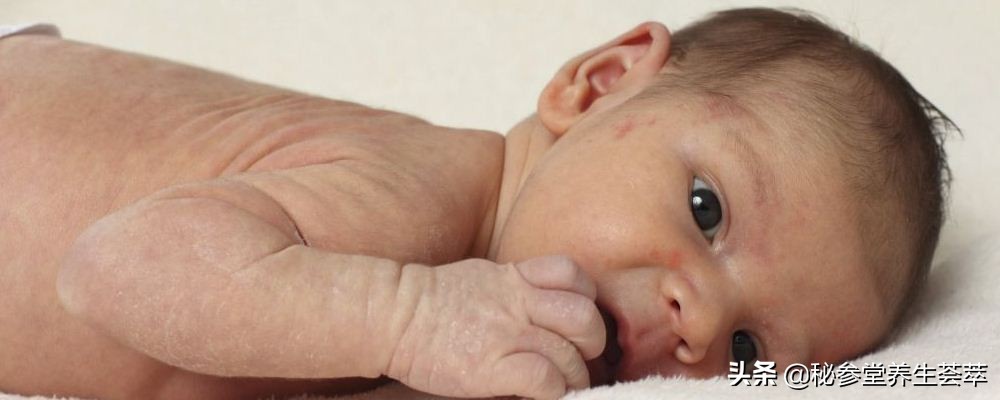 小儿*麻疹荨**需重视出现3大症状要当心