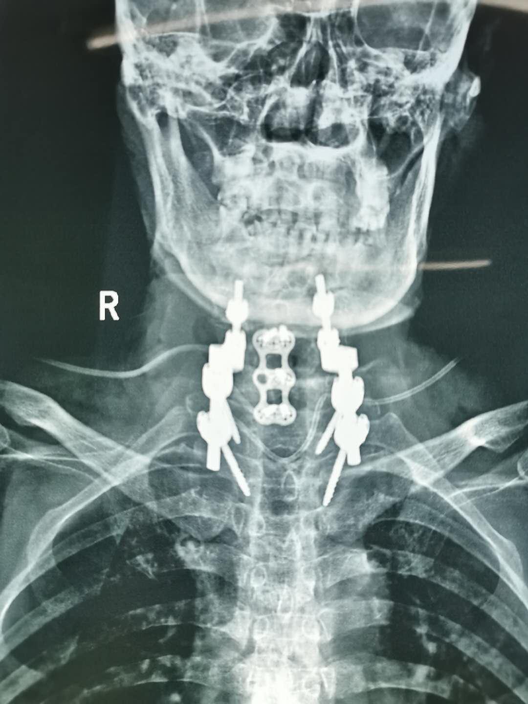 锦州市二医院骨科图片,锦州二医院颈椎手术怎么样