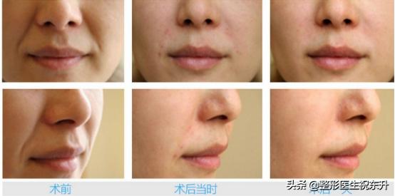 法令纹最快去除的方法医美,法令纹的去除的几种方法医美