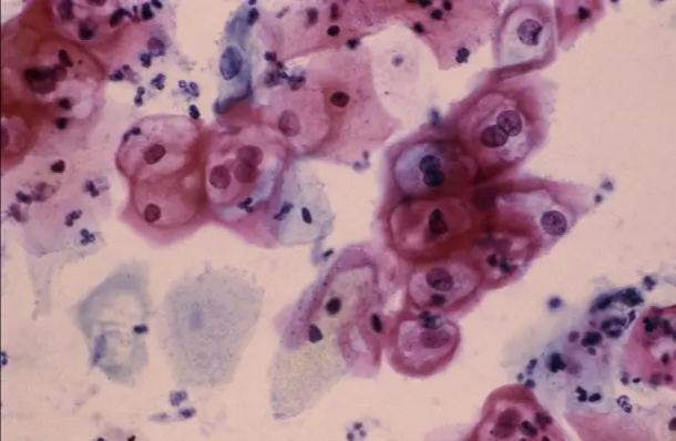 HPV反复发作不见好可能是宫颈癌?预防HPV有捷径,这些功课需做全