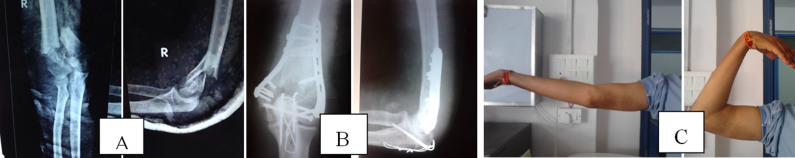 肱骨髁上骨折使用什么钢板,肱骨近端骨折保守治疗会粘连吗