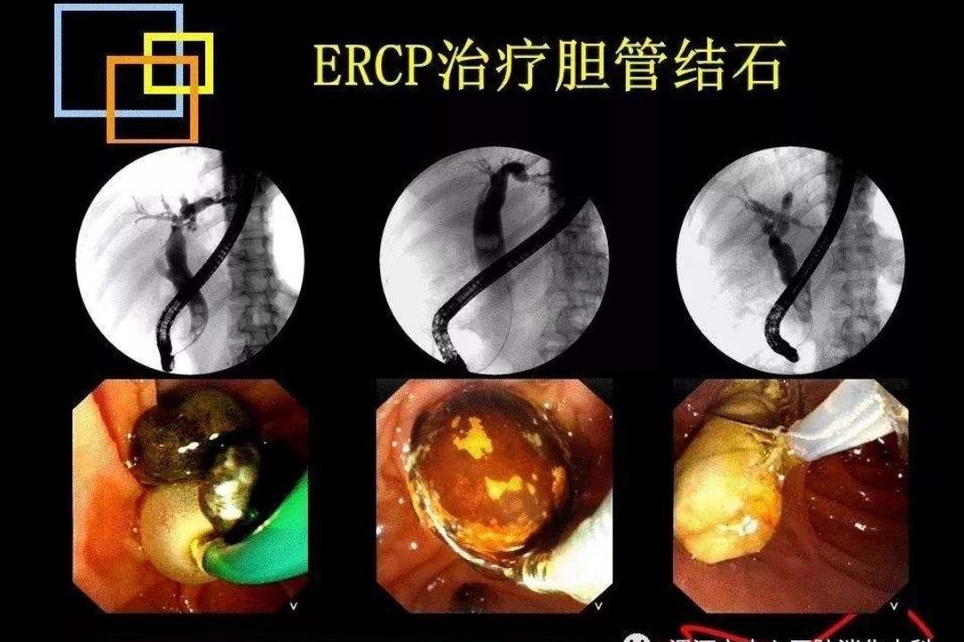 消化内镜技术近5年的新进展,腹腔镜下胆总管切开取石术恢复快